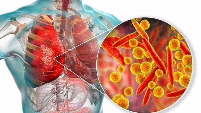 Pneumonie může být mírná i životu nebezpečná. Jaké typy existují? - Zdraví.euro.cz