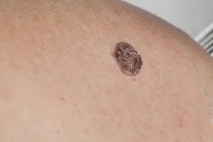 Keratinizing spinocelulární karcinom kůže — Stock obrázek