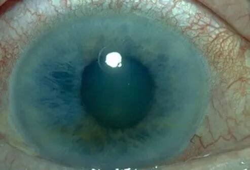 Glaucoma Causes, Visions Symptoms, Medication & Hereditary