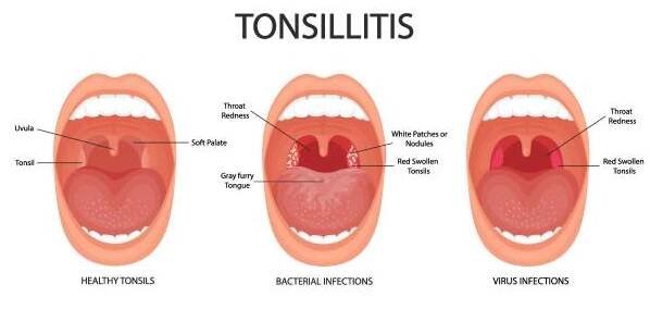 angina pectoris, faryngitida a tonzilitida. tonzilitida bakteriální a virová. infekce mandlí. otevřená ústa, anatomie. - uvula stock ilustrace