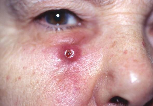Squamous Cell Carcinoma (SCC) | American Skin Association
