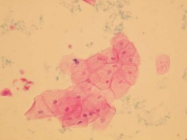 Epitelie | Mikroskopické vyšetření moče | Lékařská fakulta Masarykovy univerzity