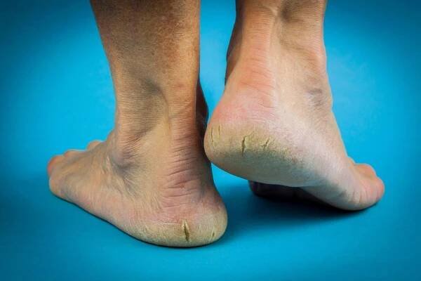 Cracked Heels removal, Podiatry Wantage, Podiatry Oxford