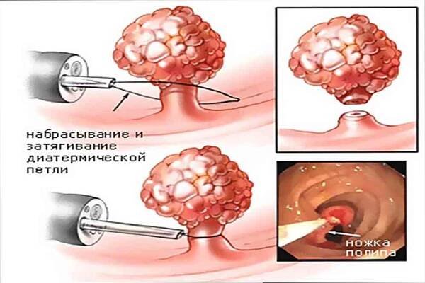 Anal polyp příčiny, příznaky, léčba / Proktologie | Užitečné informace a tipy na péči o sebe. Zdraví, výživa a další.