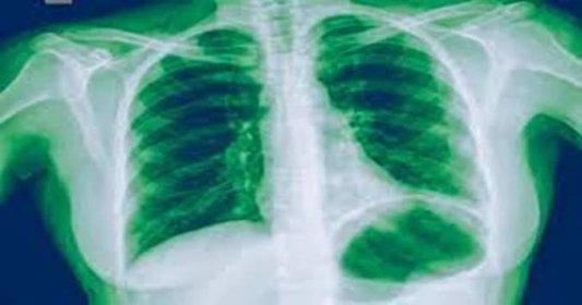 Tyto příznaky zápalu plic podceňuje drtivá většina lidí. 94 % pacientů později vzpomíná na jejich ignoraci. Měl by je však znát každý