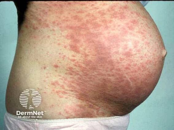 Pemphigoid gestationis