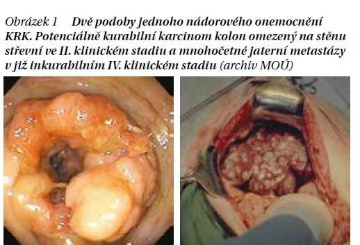 Kolorektální karcinom dnes - PROFI Medicína