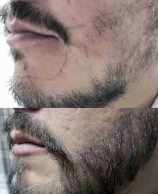 baard-implantaat-resultaat
