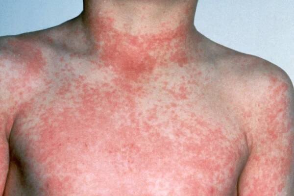 The Basics of Scarlet Fever