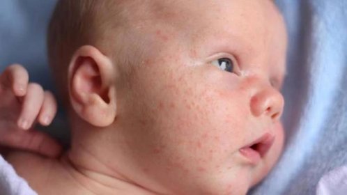 Jak poznáte novorozenecké akné a jak ho léčit?