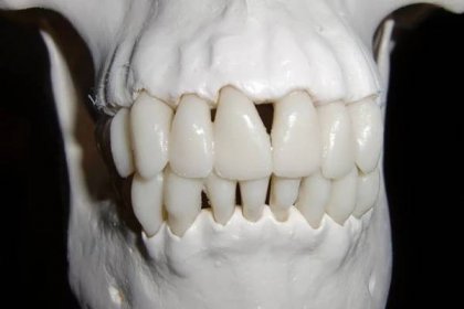 Hrůza na zubařském křesle: bolavý zub doporučovali léčit havraním lejnem a vytržení zubu nejednou končilo smrtí pacienta