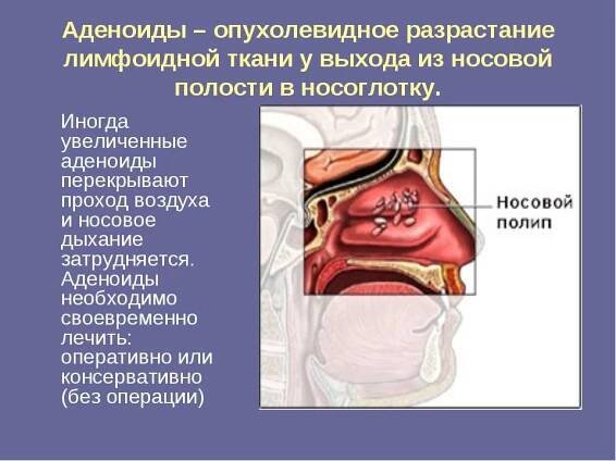 Аденоиды