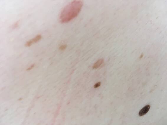 Nezhoubné a zhoubné útvary na kůži | Dermaweb