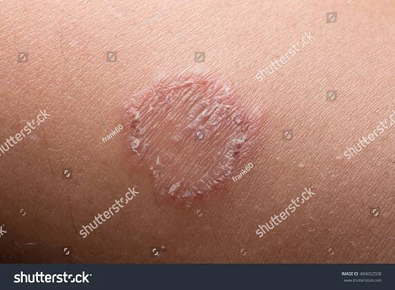 Ring Worm infekce, dermatofytóza na kůži Stock fotografie 484652500