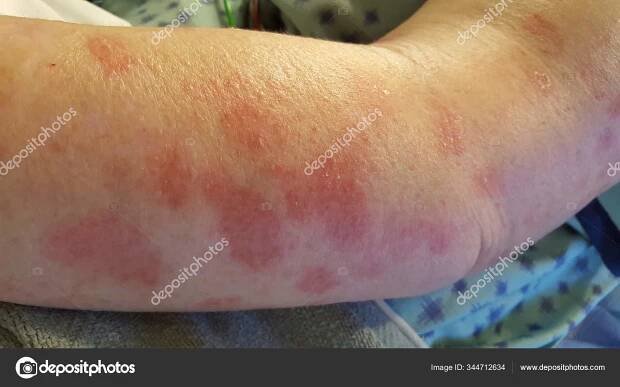 Erythema multiforme annulární erytematózní cílené kožní léze — Stock Fotografie © CreativeEndeavors6@gmail.com #344712634