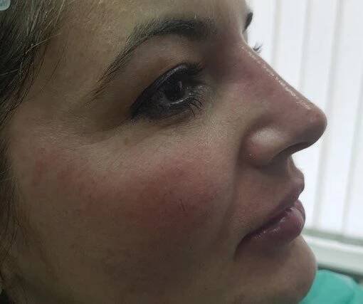 Nechirurgická modelace nosu – rhinoplastika