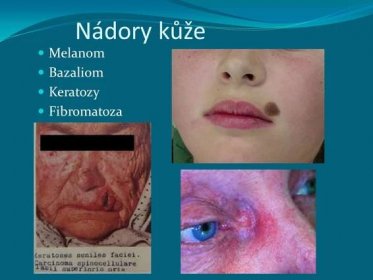 Nádory kůže Melanom Bazaliom Keratozy Fibromatoza