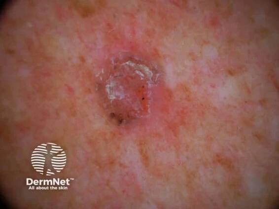 Basal cell carcinoma affecting the trunk