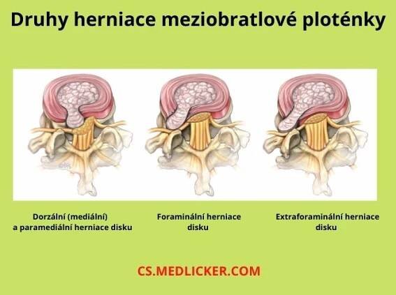 Podle závažnosti postižení meziobratlové ploténky rozlišujeme protruzi, herniaci a sekvestraci disku