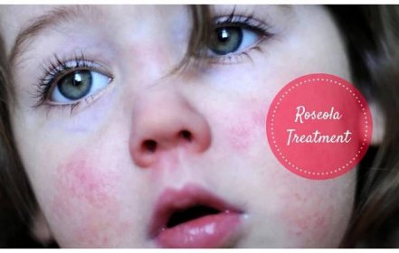 What Causes Roseola In Adults