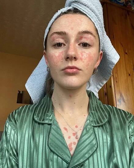 Sestřička (22) trpí extrémní lupénkou: Leopardí skvrny vypadají jako popáleniny