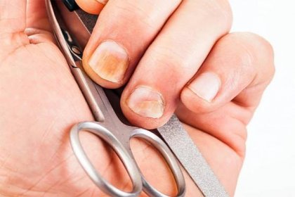 Odstraňte žluté nehty pomocí osvědčeného domácího postupu