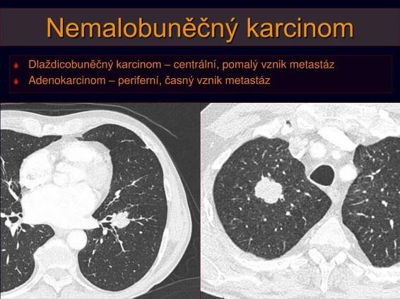 PPT - Nádory plic, pleury a mediastina: BRONCHOGENNÍ KARCINOM PowerPoint Presentation - ID:5892677