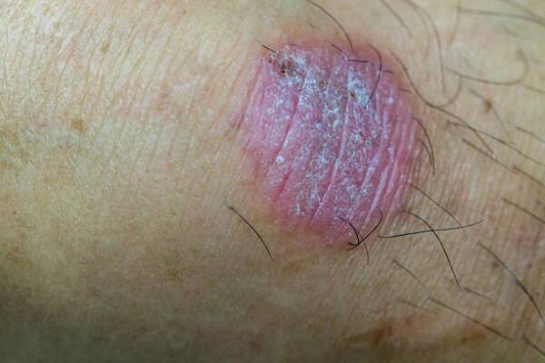 infekce kruhového červa, dermatofytóza na kůži. kožní infekce nebo tinea na kůži. infekce mykózy na lidské kůži. je způsobena houbou - erysipel vyrážka - stock snímky, obrázky a fotky
