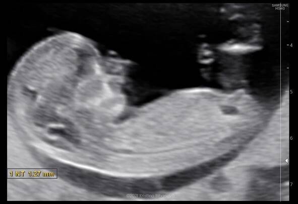 3D sonografia / 3D ultrazvuk - Prvý trimester - Celý plod