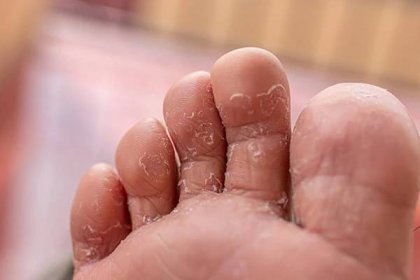 Houba mezi prsty na nohou — léčba, příčiny, příznaky