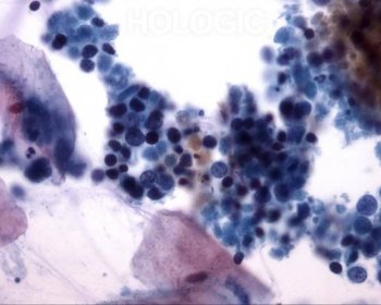 Respiratory Cytology – Small Cell – Undifferentiated Carcinoma – CytologyStuff