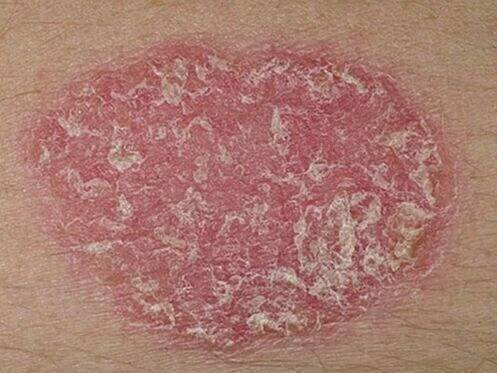 Psoriáza: příznaky, léčba a prevence