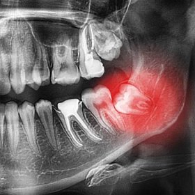 rentgenové záznamy zubů, ortopantomogram chrupu, spodní zuby moudrosti jsou osmé zuby jsou nakloněny, dystopie, poluretan, retence, rentgen, patologie, komplexní zuby moudrosti - zub moudrosti - stock snímky, obrázky a fotky