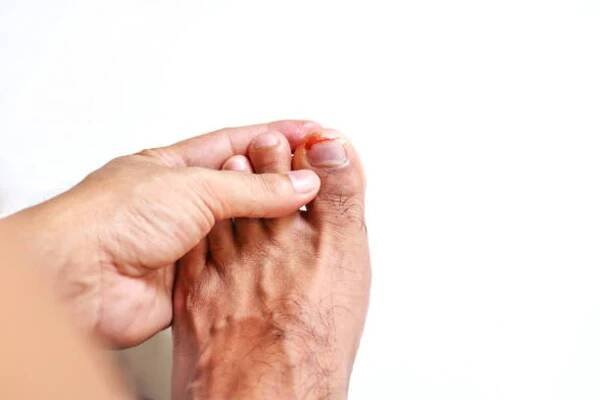 Přijít na hřebík, nehoda na nehty traumatu, krvácení toe nehty, vředů na nohou přijít na hřebíku, Onychocryptosis — Stock obrázek