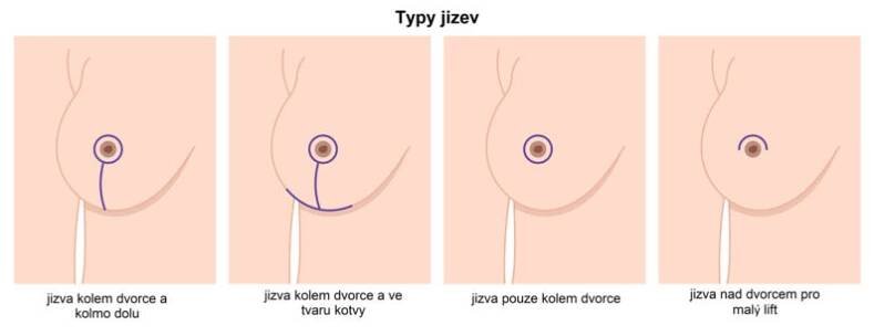 typy jizev po modelaci