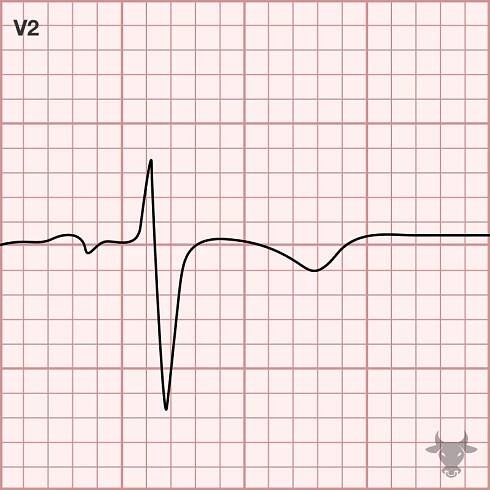 Persistent Juvenile T Wave Pattern