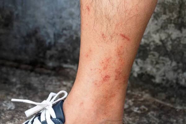 kožní onemocnění v zimě. zdravotní suchá prasklá kůže a vyrážka červená noha na během počasí zima. dermatolog a koncepce léčebných léků. - kopřivka - stock snímky, obrázky a fotky
