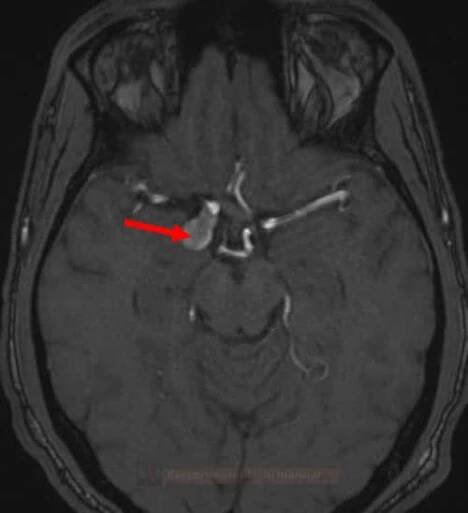 mra_aneurysm01_original
