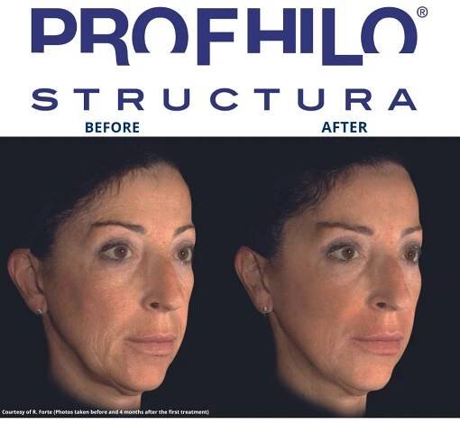 PROFHILO STRUCTURA®