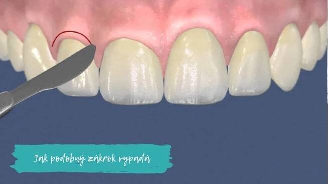 Plastika dásně: jak se zbavit tmavého krčku implantátu nebo tmavého krčku zubu | Dsmile