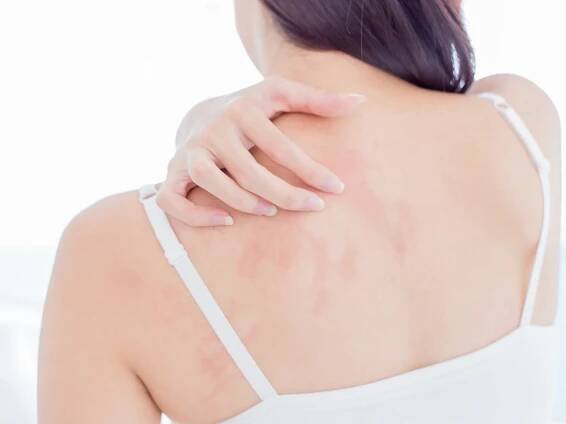 Neurodermitis (Atopische Dermatitis)