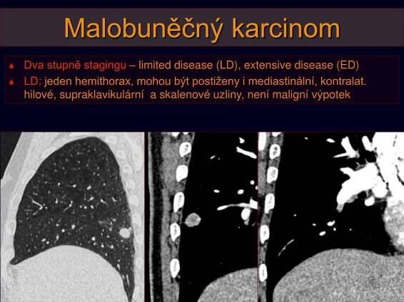 PPT - Nádory plic, pleury a mediastina: BRONCHOGENNÍ KARCINOM PowerPoint Presentation - ID:5892677