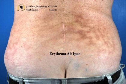 Erythema Ab Igne: Stop Using The Heating Pad... - Academic Dermatology of Nevada