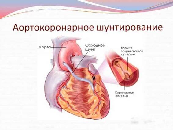 Operace bypassu koronární arterie a pooperační období / Kardiologie | Užitečné informace a tipy na péči o sebe. Zdraví