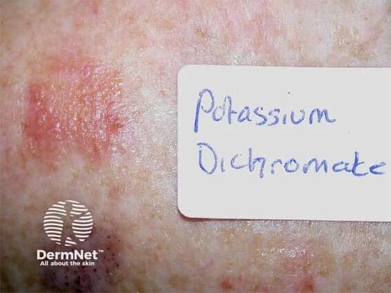 Positive patch test to potassium dichromate
