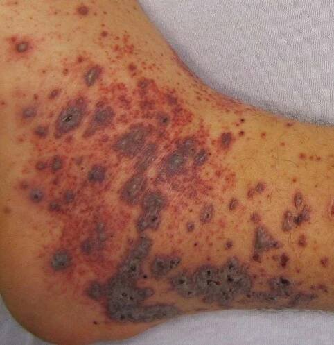 Petechiae: Causes and treatments