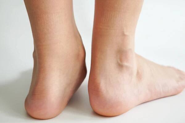 Carrollton Texas Deformed Feet