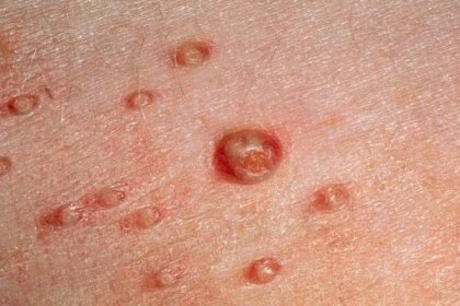 These itchy bumps pop up in areas like the face, lower belly, upper thighs, and genitals.