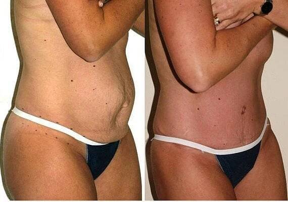Problém se také někdy řeší abdominoplastikou - estetickou operací břicha