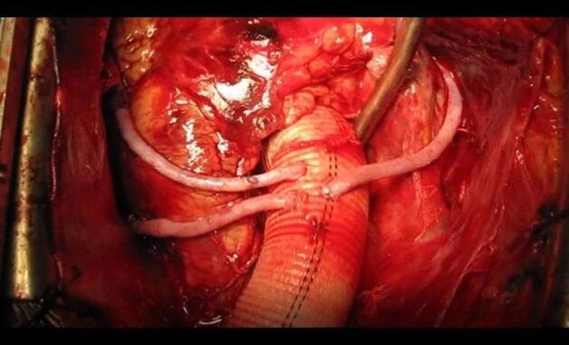 Breakthrough Cases